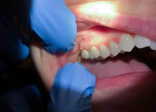 Best Emergency Dental Care for Abscessed Tooth in Hoopeston, IL